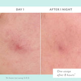 S.O.S Totally Invisible Clarifying Liquid Patch